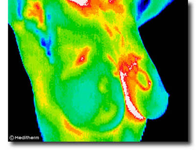 Painless Breast Health Screenings: The Thermography Option